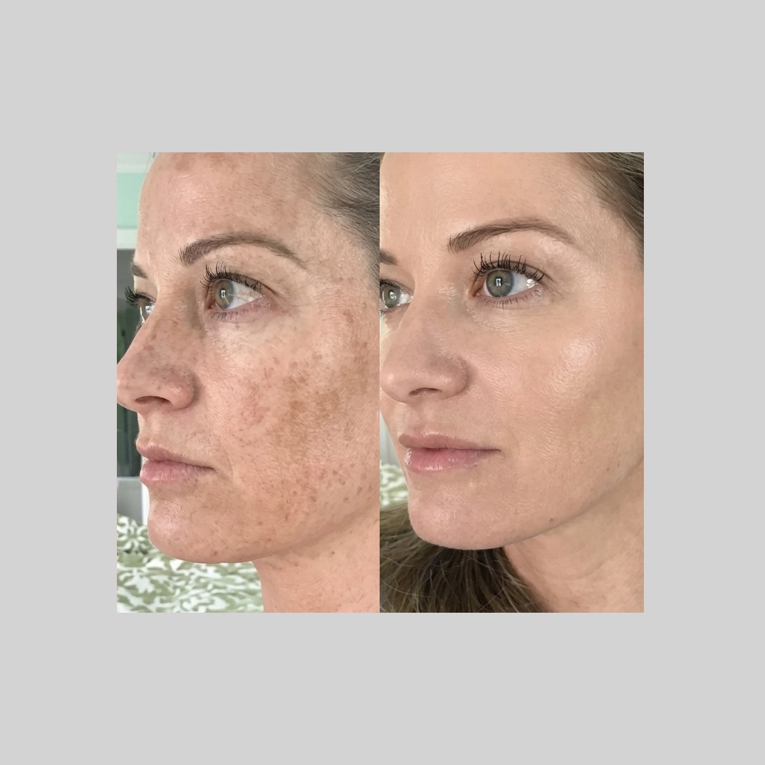 Chemical-Peels-before-after-f