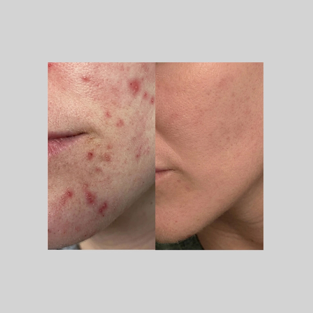 Chemical-Peels-before-after-g