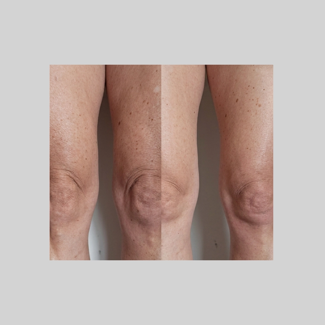 coolSculpting-before-after-a