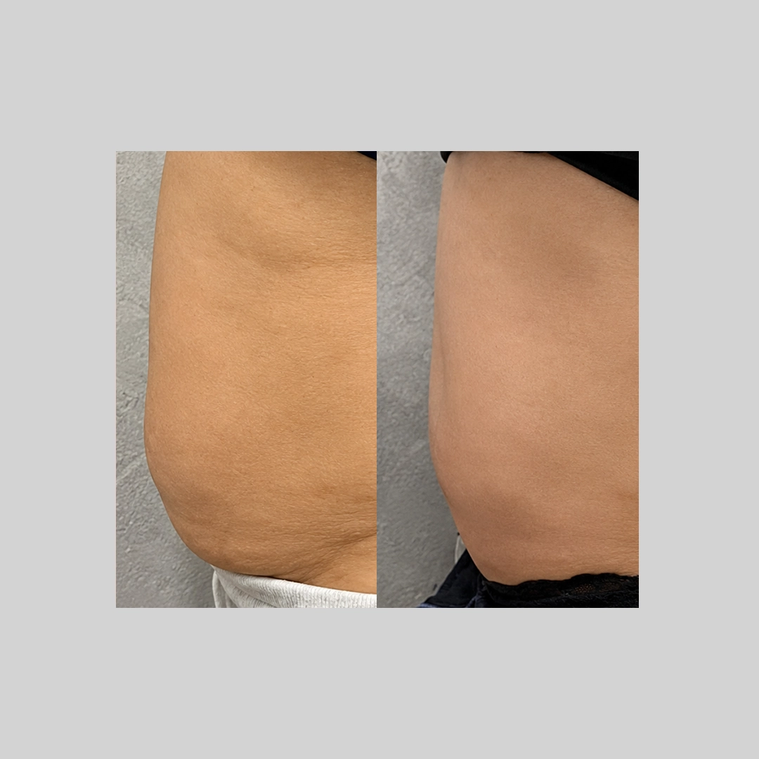 coolSculpting-before-after-b