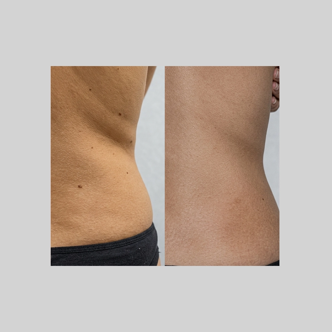 coolSculpting-before-after-c
