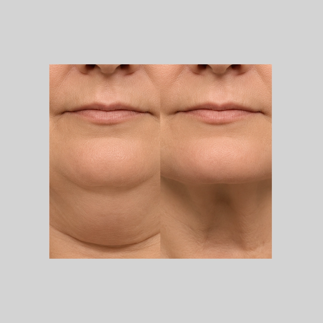 coolSculpting-before-after-d