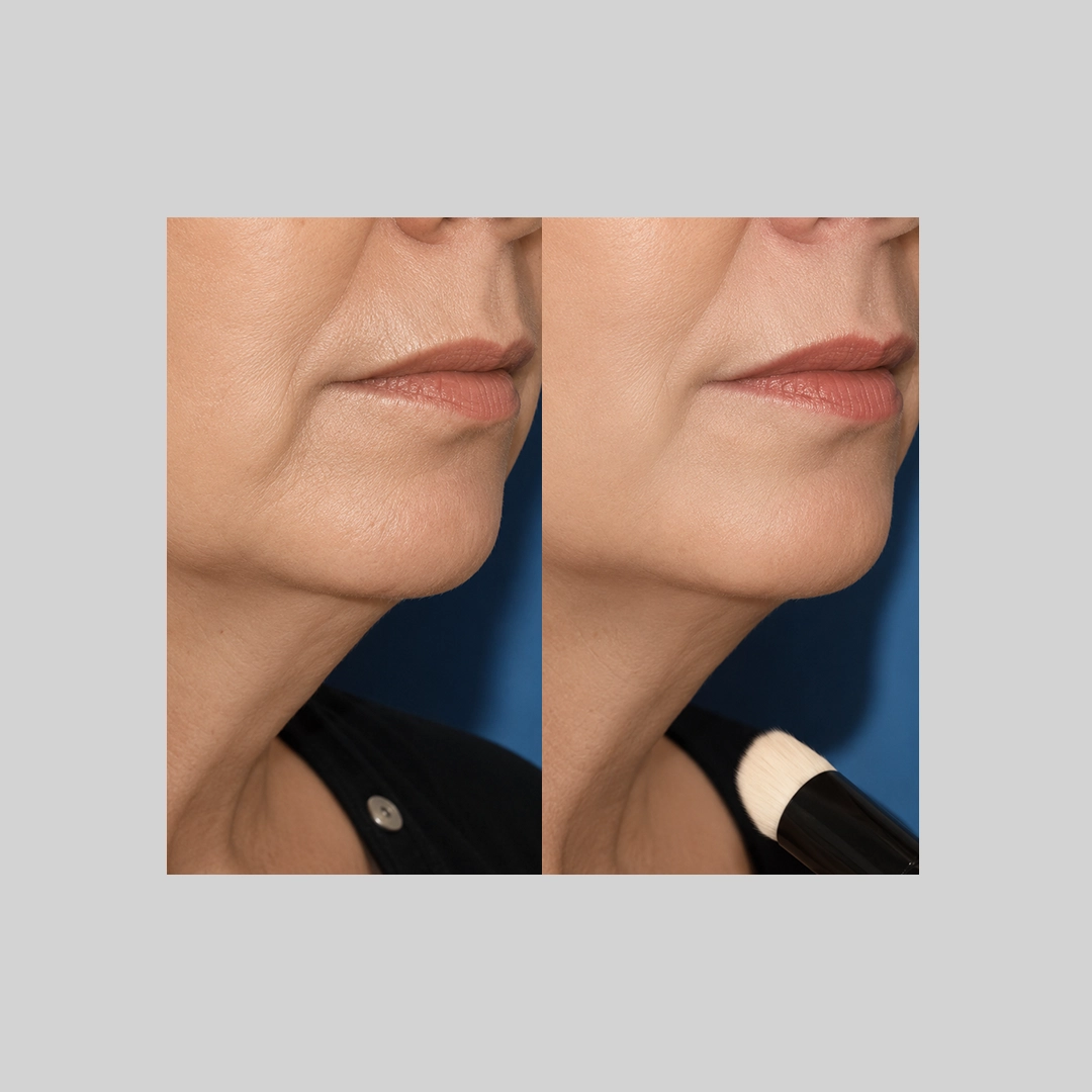 coolSculpting-before-after-f