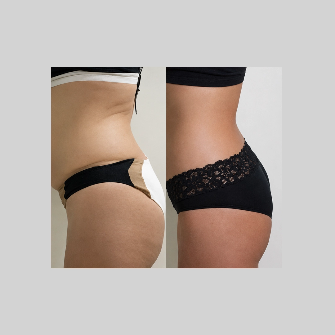 coolSculpting-before-after-g