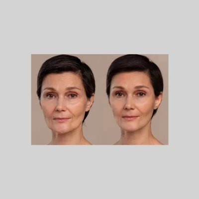 Vampire-Facial-PRP-d