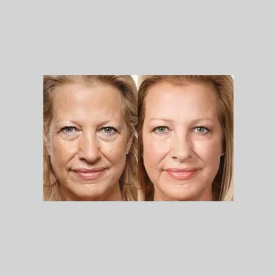 Vampire-Facial-PRP-e