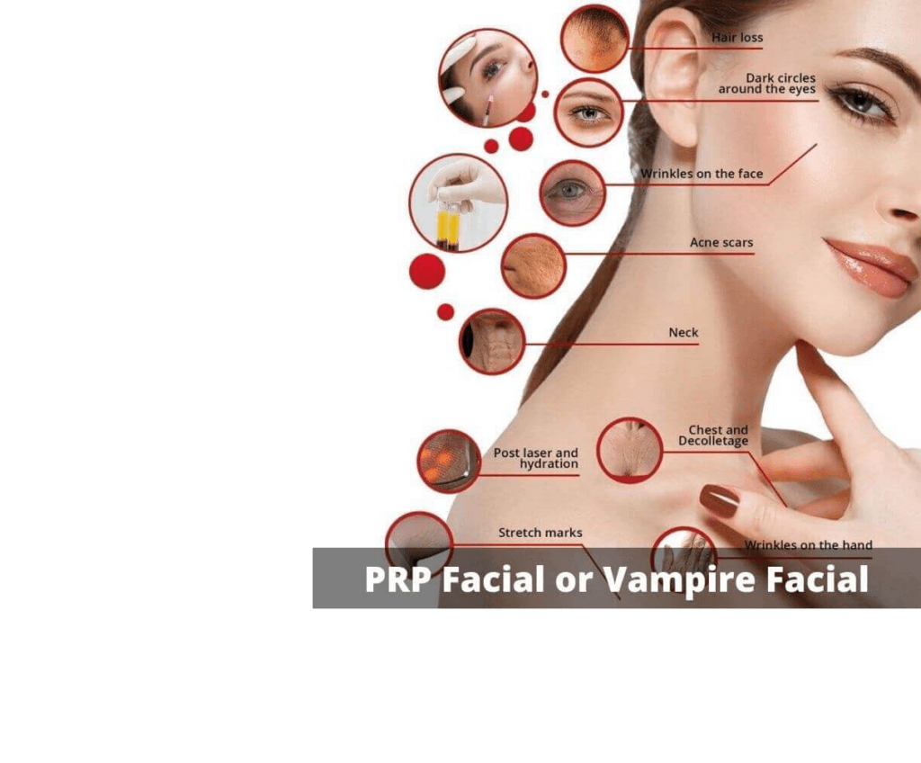 Vampire Facial PRP Treatment in Portland, OR: Soleil Medical